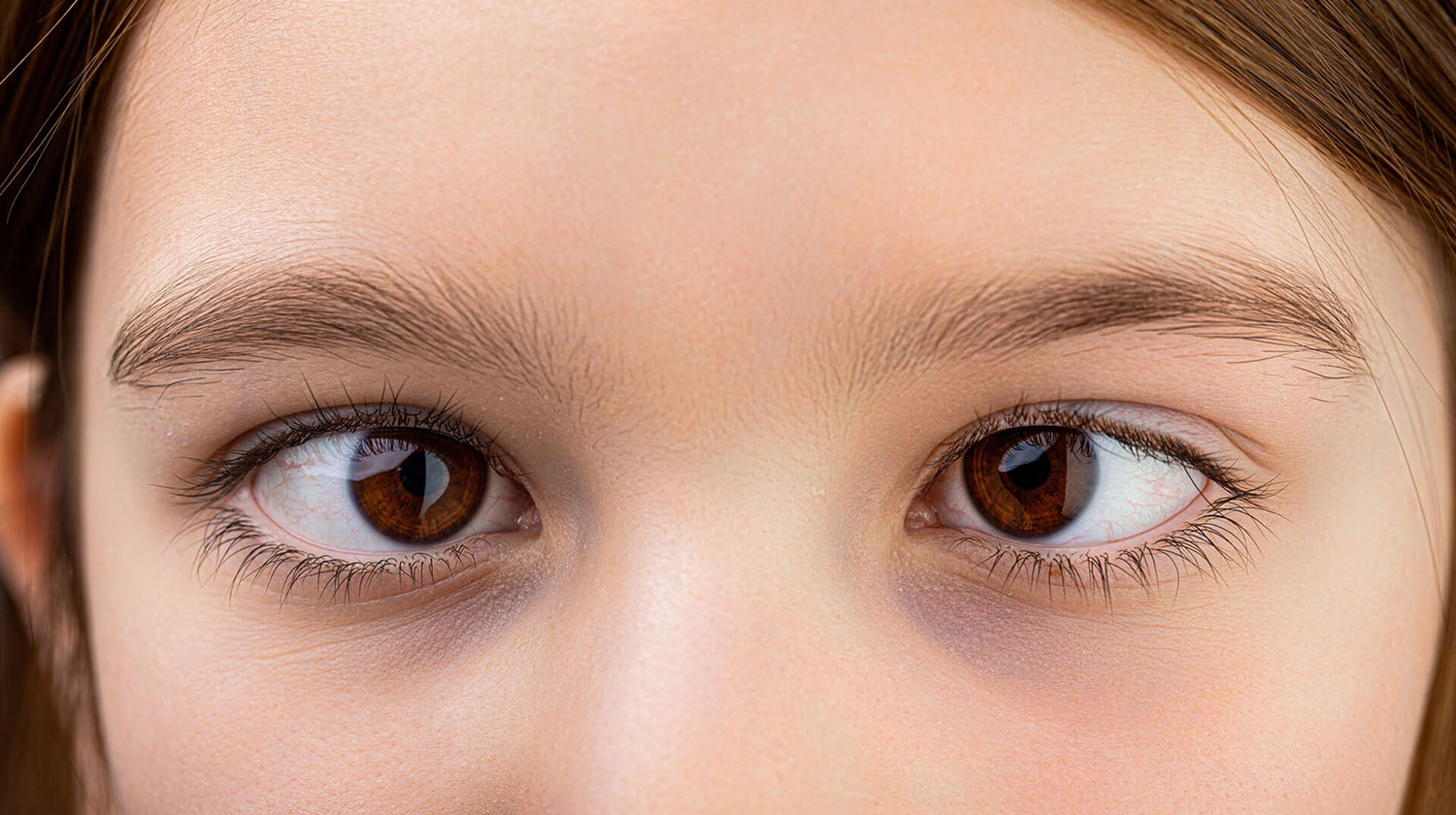Mata Juling (Strabismus): Kenali Penyebab, Gejala, dan Cara Pengobatan yang Tepat