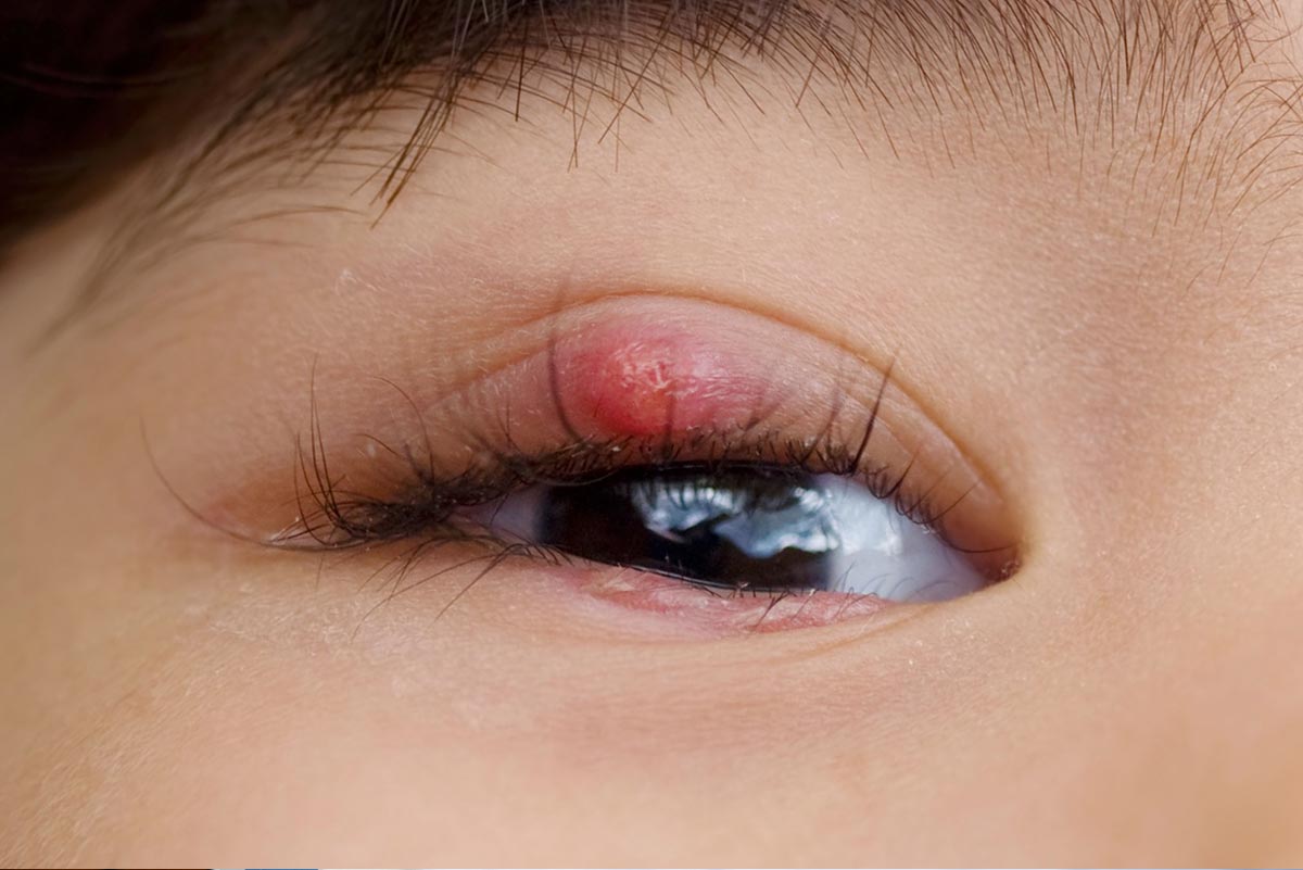 Penyebab Mata Bintitan dan Cara Mengatasinya dengan Tepat