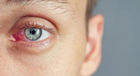 Radang Kelopak Mata: Kapan Harus ke Dokter dan Cara Mengatasinya