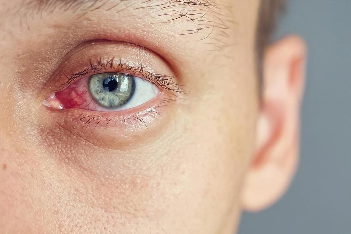 Radang Kelopak Mata: Kapan Harus ke Dokter dan Cara Mengatasinya
