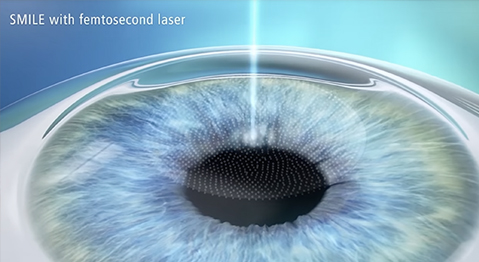 Persiapan Sebelum LASIK