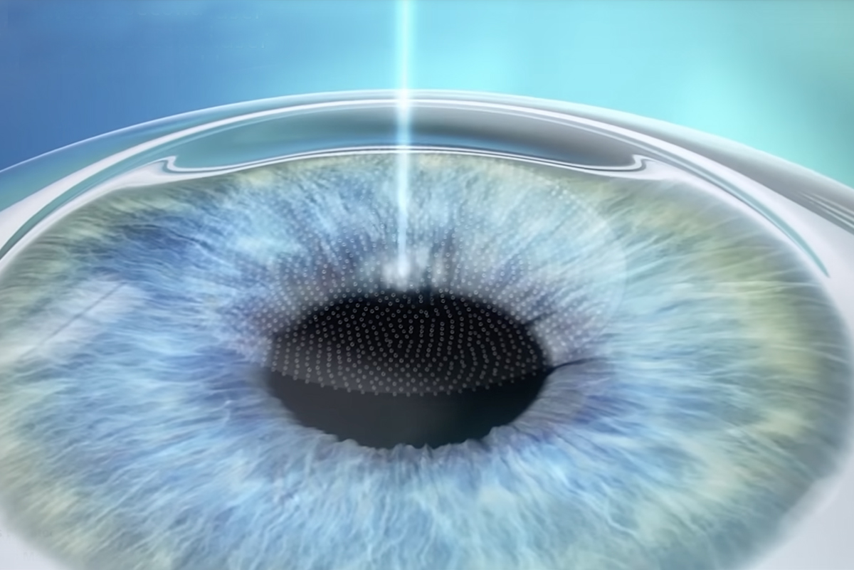 Persiapan Sebelum LASIK